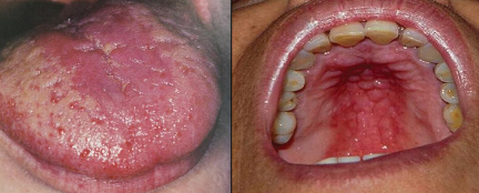 <p>What is acute atrophic candidiasis?</p>