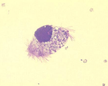 <p>with enterocentesis, will see:</p><p>-plant matter</p><p>-mixed extracellular bacteria and protozoa</p><p>-variable TP</p><p><u>-low nucleated cell count/white blood cell count (<1000); can increase tho in subsequent taps by 4 hours</u></p>