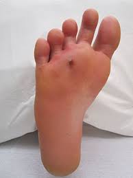 A wound when something was poked and removed 