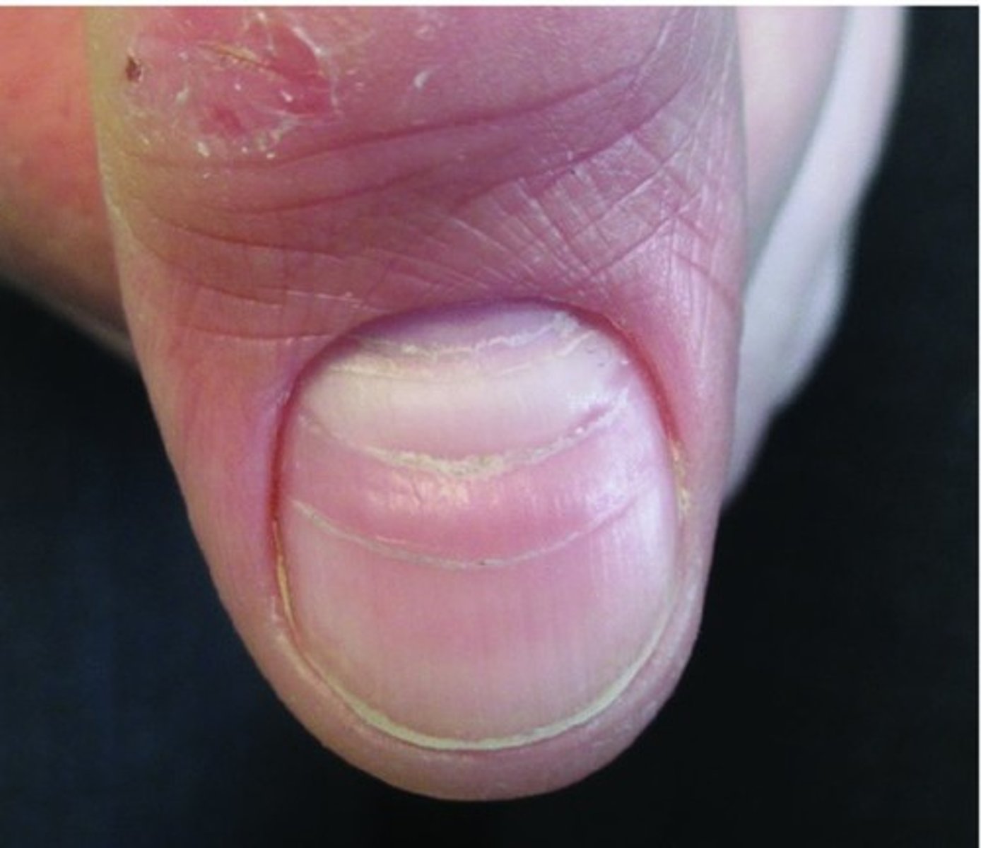 <p>transverse depressions in the nail plates, usually bilaterally</p>
