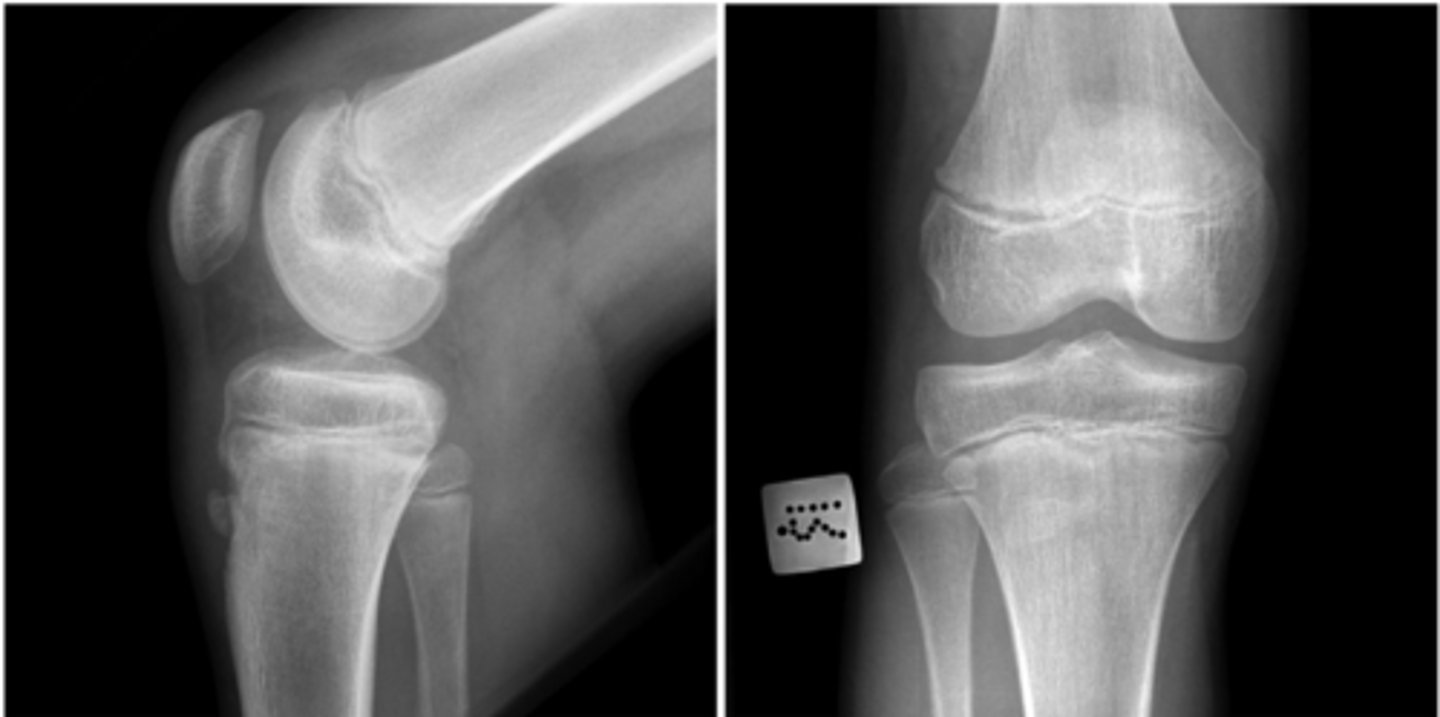 <p>A 13-year-old boy with a medical history of asthma presents to the pediatrician’s office for evaluation of right knee pain. He states that it has been ongoing for several weeks since the start of soccer preseason training. He reports no injury to the knee and no numbness or tingling. The pain is localized to his anterior knee, and he describes it as aching and throbbing and worse after practice. He has no pain with weight-bearing on the right extremity. Vital signs are a temperature of 98.0°F, heart rate of 88 bpm, blood pressure of 112/72 mm Hg, respiratory rate of 14 breaths/min, and oxygen saturation of 98% on room air. On physical examination, the anterior knee is tender to palpation over the tibial tubercle. Radiographs are obtained and are shown above. What is the pathogenesis of this injury?</p><p>ABursal inflammation from repetitive direct pressure</p><p>BChronic traction apophysitis of the tibial tubercle apophysis</p><p>CReferred pain from slipped capital femoral epiphysis</p><p>DRepetitive strain on the patellar tendon</p>
