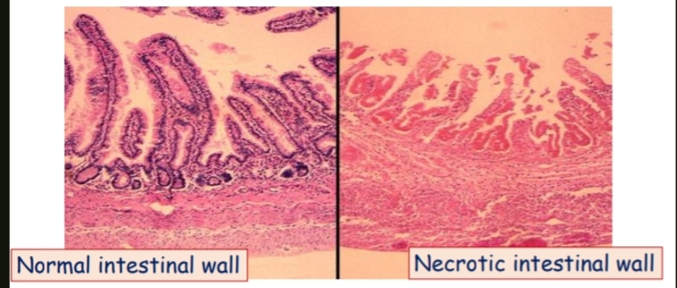 <p>necrotizing inflammation</p><p>Main feature:excess tissue necrosis </p><p>1 normal </p><p>2 necrotic </p><p>) مش هيجيلي صورة لل normal في الامتحان و لكن خليكم عارفين الفرق بس )</p>