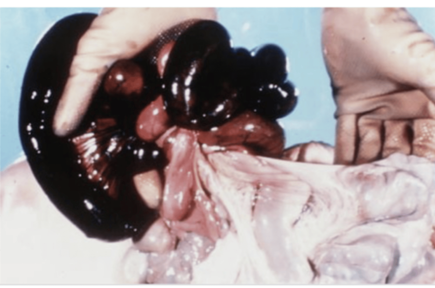 <p>dark red/purple</p><p>because the intestinal torsion obstructs the venous outflow, causing acute passive local congestion</p>