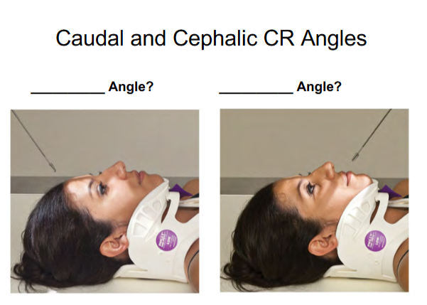 <p>Caudad Angle </p>