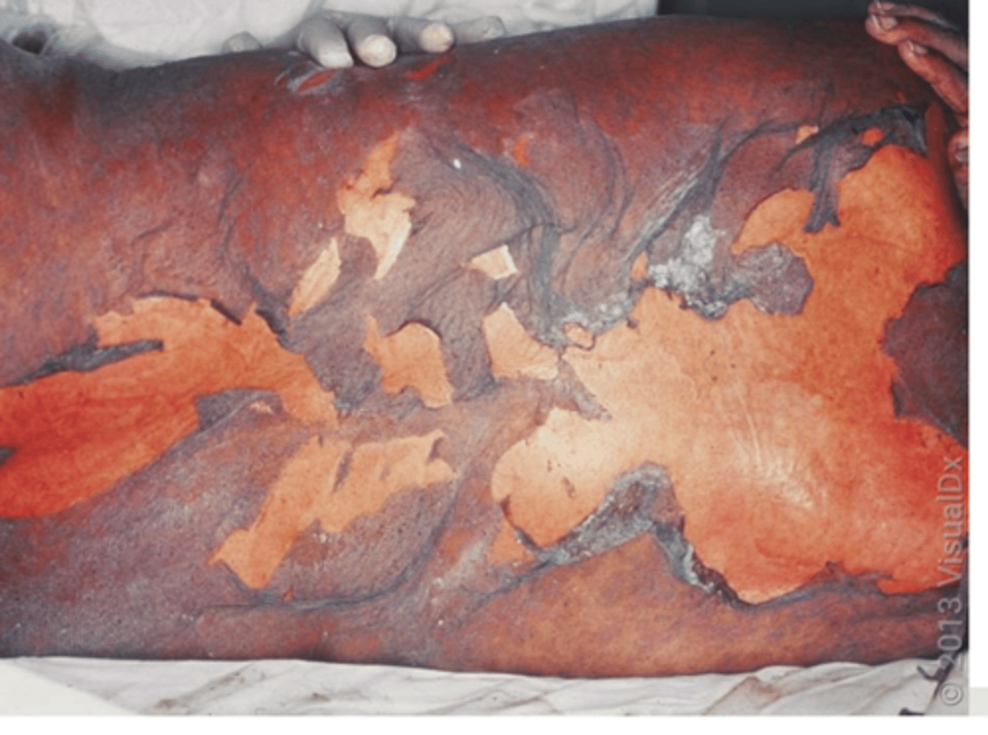 <p>- extensive skin and mucosal necrosis accompanied by systemic toxicity.</p><p>- usually occurs as a drug reaction (few days -1 month after) - NOT IMMEDIATE</p>