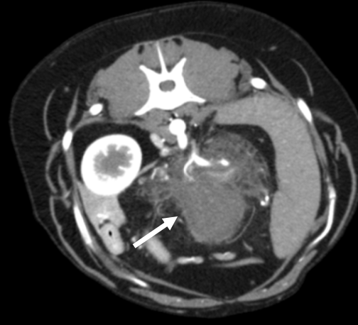 <p>-able to visualize entire pancreas</p><p>-better identification of acute pancreatitis, abscessation, masses than ultrasound</p><p>-identification of portal vein thrombosis</p>