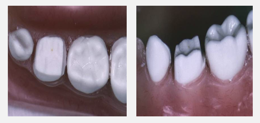 <p>mesial/ distal reduction with ledge</p>