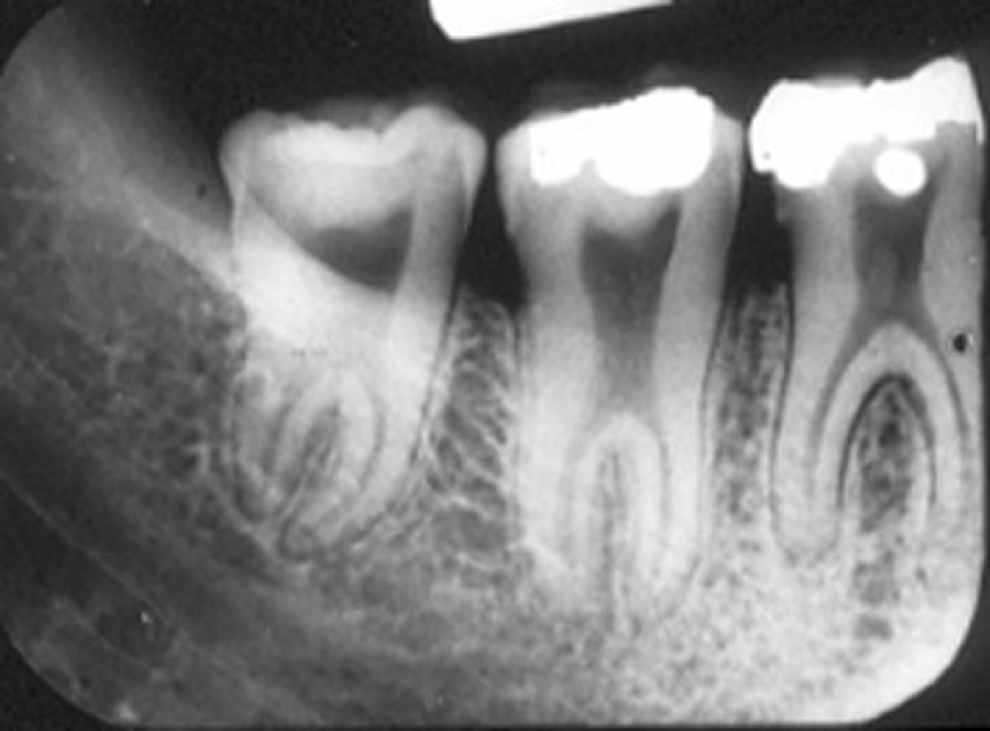 <p>Elongated root trunk, both primary and permanent tooth can be involved</p>