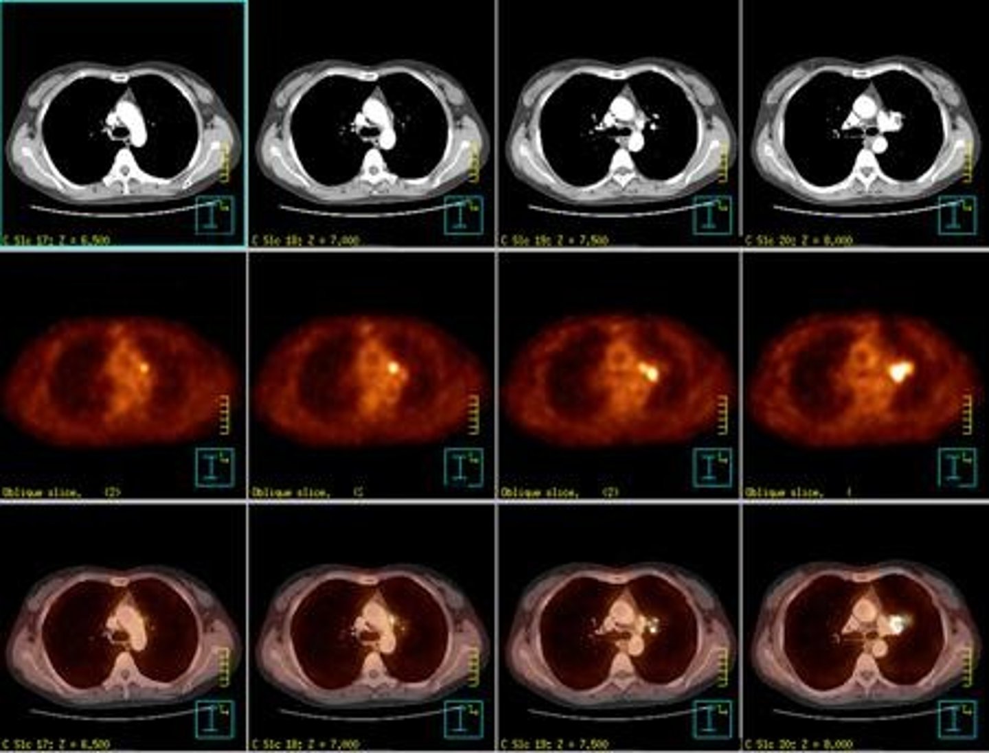 <p>They are widely used for staging lymphomas and lung cancers and for simulation purposes.</p>