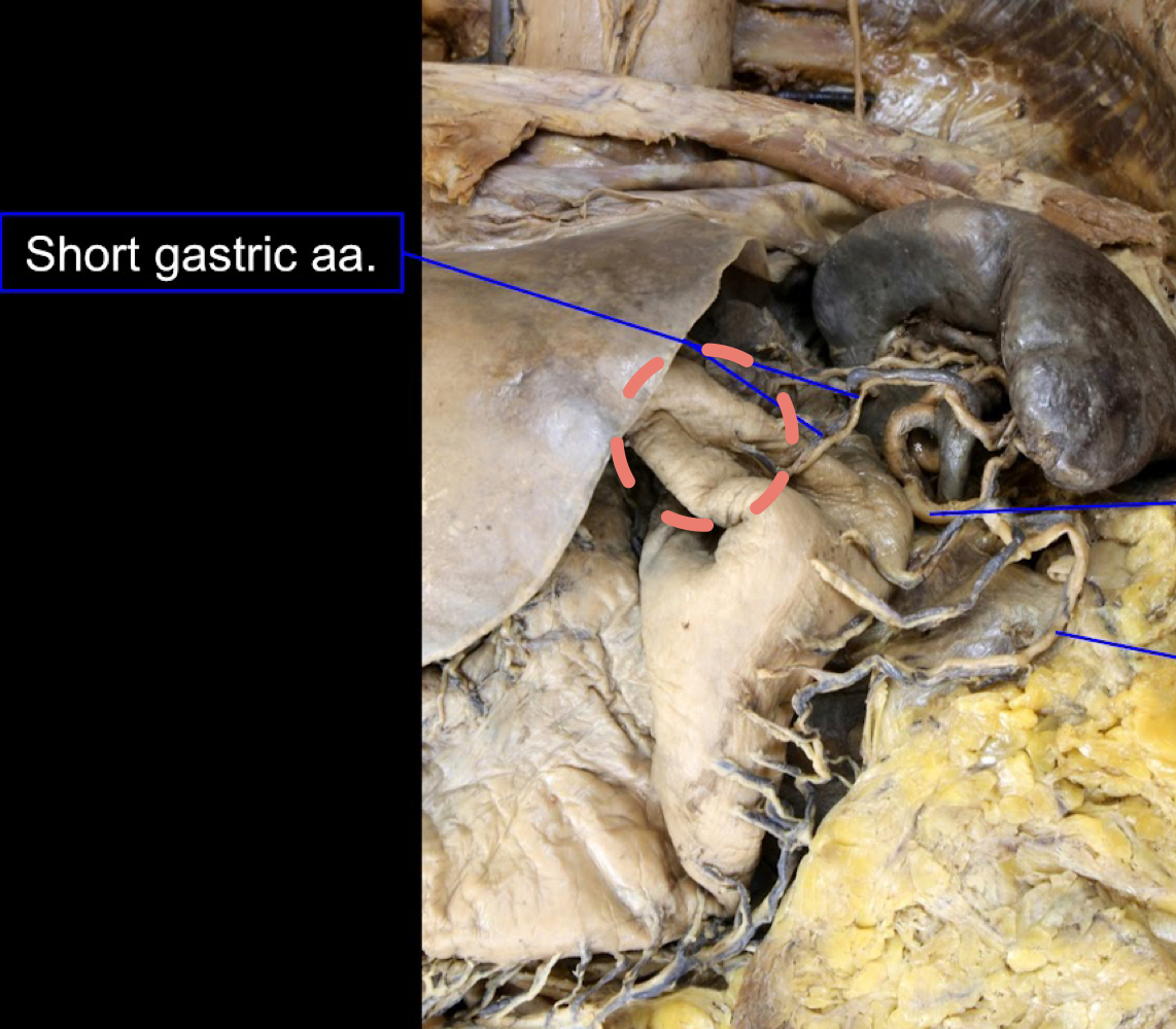 <p>A). fundus of the stomach<br>B). short gastric arteries</p>