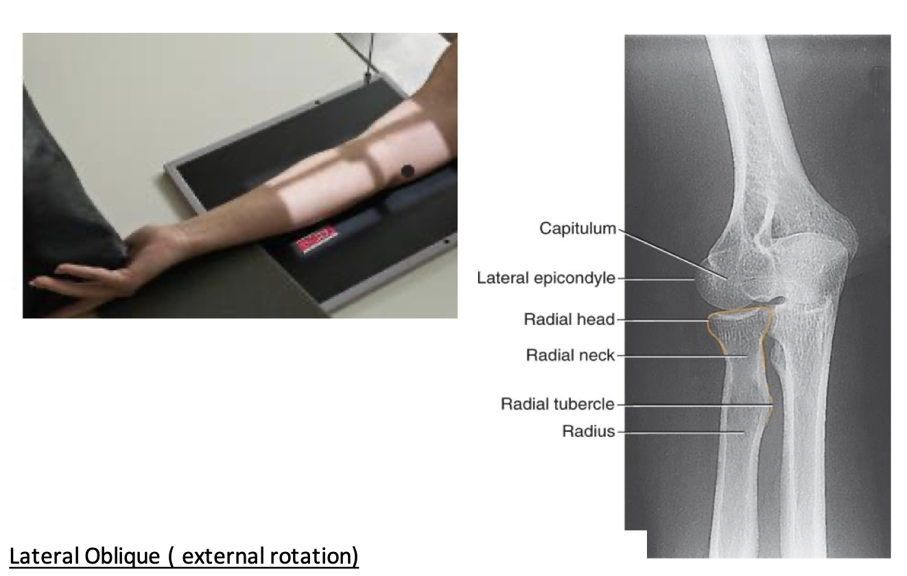 <p><span style="line-height: normal;"><span>• </span></span>Radial head, neck, and tuberosity in profile and free of superimposition</p><p class="p1"><span style="line-height: normal;"><span>• </span></span>Lateral epicondyle and capitulum in profile</p>
