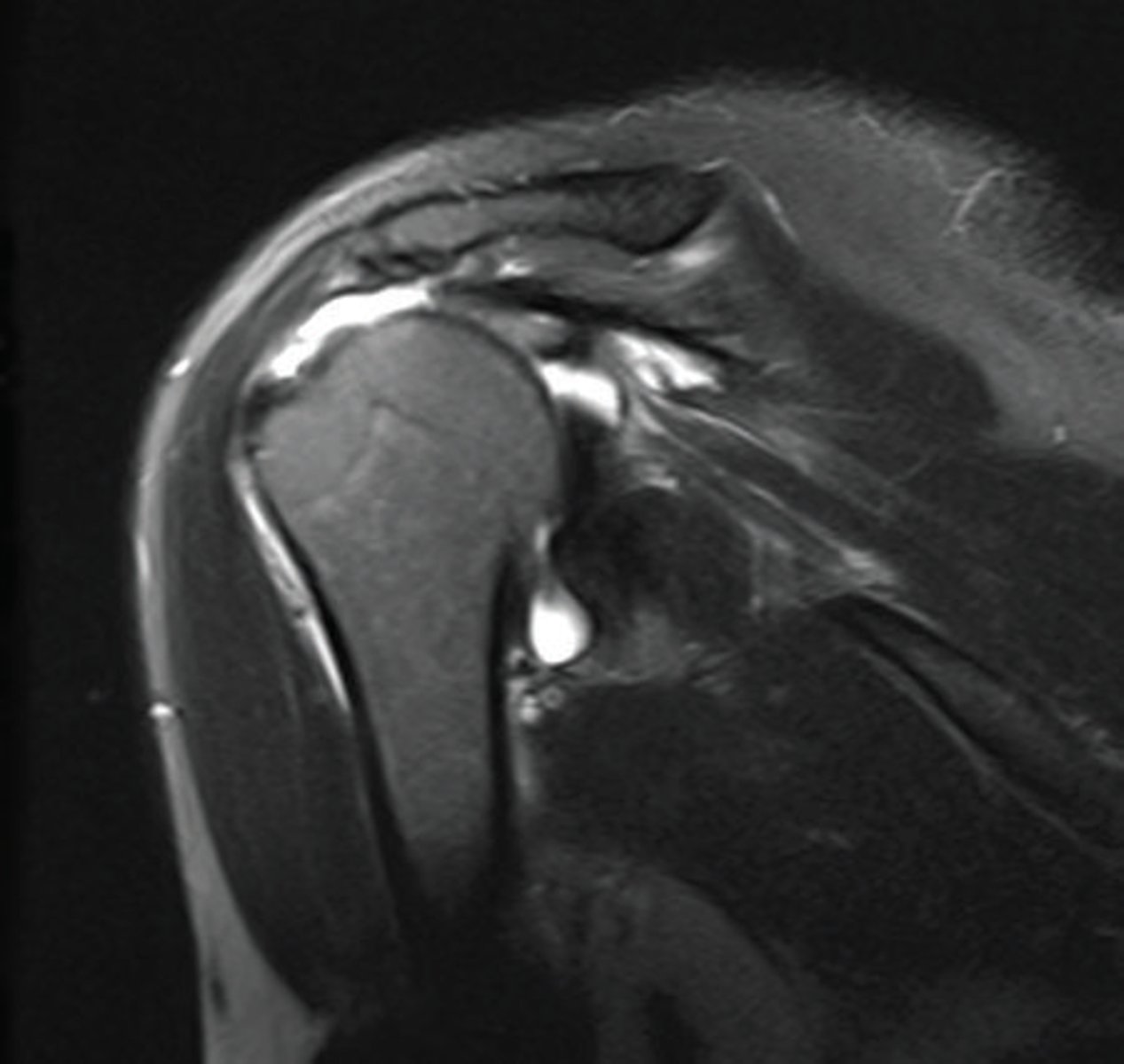 <p>can be repaired by stitching it to the remaining supra, which covers the humerus, as it is on the side of the greater tubercle</p>