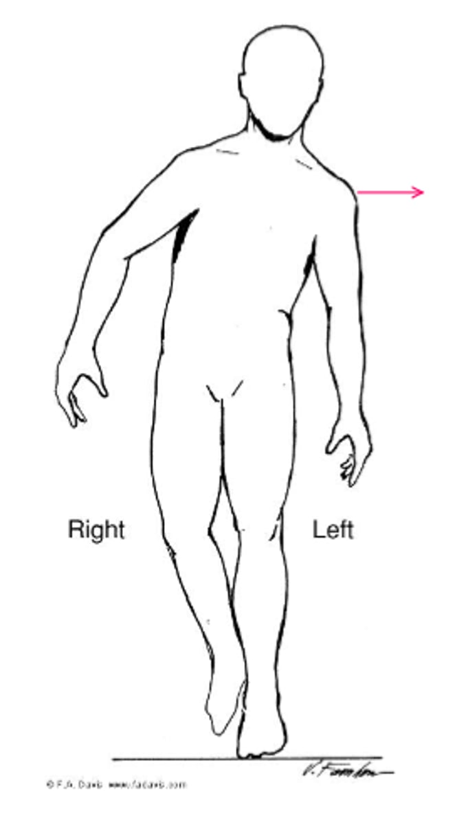 <p>muscular involvement</p><p>weakness - results in Gluteus Medius Lurch (ipsilateral lean) if compensated or a Trendelenburg Gait (dropping of the contralateral pelvis) if uncompensated</p><p>*may be seen with gluteal medius tendinopathy</p><p>IMAGE = LURCH</p>