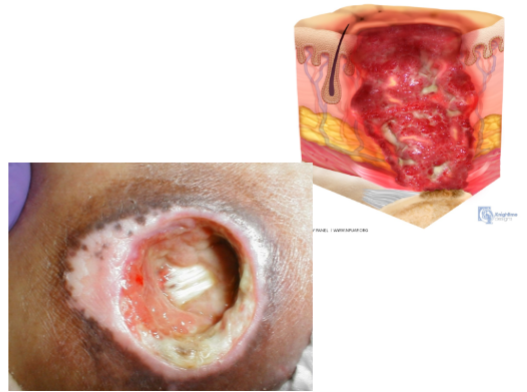 <ul><li><p>full thicken skin &amp; tissue loss w/ exposed fascia, muscle, tendon, ligament, cartilage, or bone in the ulcer</p></li><li><p>epibole, slough, and eschar often visible-</p></li></ul><p></p>