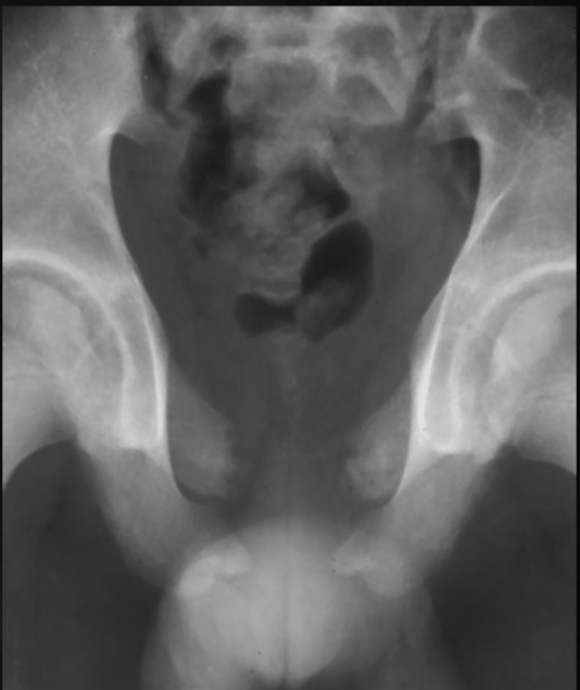 <p>what is seen here for this case of cleidocranial dysplasia?</p>