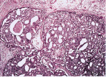 Nobular hyperlasia