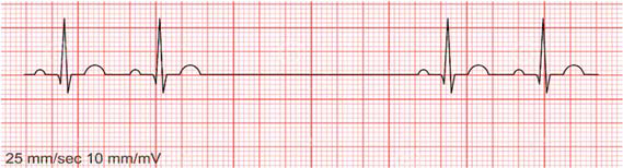 <ul><li><p>sudden absence of electrical activity in SA node → no depolarization/contraction</p></li><li><p>6 second pause = medical emergency, call 911 and carry out emergency procedures </p></li></ul><p></p>