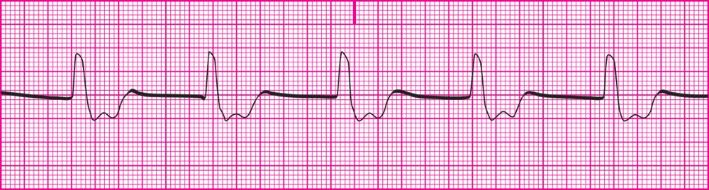 <p>impulse created by the ventricular pacemaker due to SA and AV node failure; QRS is wide &amp; bizarre; P waves are absent; 40-100bpm</p><p></p><p>Rhythm: R-R interval is regular; P-P interval cannot be determined</p><p>Rate: Ventricular- 40‒100 bpm; Atrial- Cannot be determined</p><p>P wave: No P wave is present</p><p>PR Interval: Cannot be identified</p><p>QRS: 0.12 second or greater; Wide, bizarre appearance</p><p></p><p>Decrease in cardiac output due to slow ventricular rate and loss of atrial kick.</p><p>Patient may be unconscious.</p><p>Notify health care practitioner immediately.</p><p>May require medication and/or pacing.</p><p>ECG strips must be saved and put in medical record.</p>