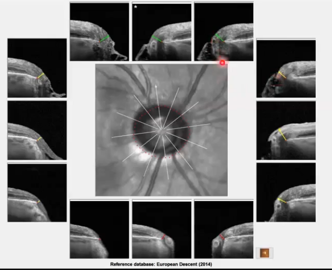 <p>BMO scans for assessing nrr</p>
