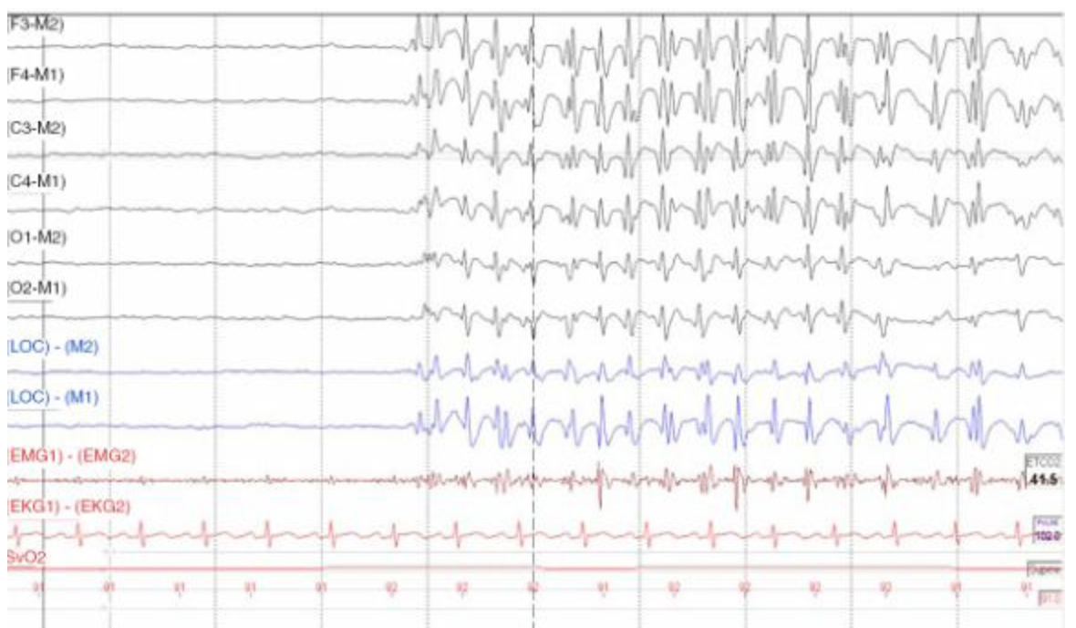 <p>A 30 year old patient with a history of excessive daytime sleepiness, loud snoring, and witness apneas comes to a sleep center for a PSG. During conversation, the patient reveals a recent hospitalization for a head injury resulting from a motor vehicle crash. The following epoch is observed. Which of the following should a sleep disorders specialist document in the scoring record? </p>