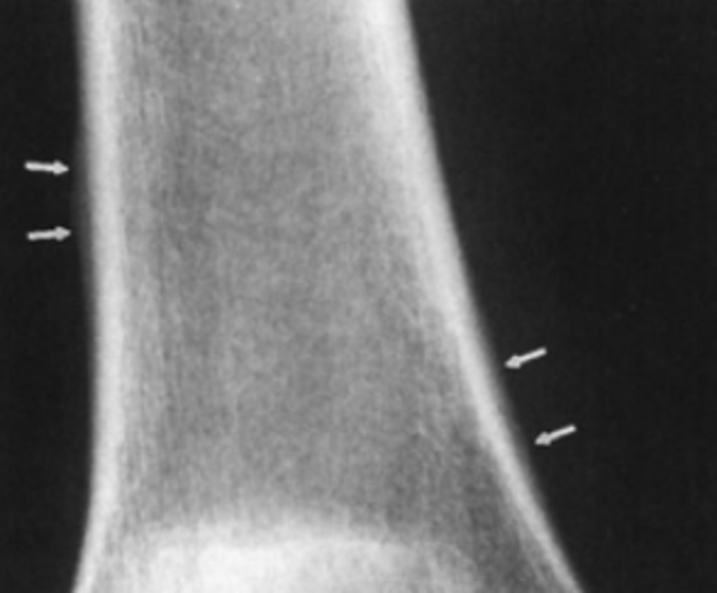<p>For Case 6-11 (Figure 6-29), what is the next study</p><p>you should order?</p><p>A. Bone scan</p><p>B. MRI of the knee</p><p>C. Hand films</p><p>D. Chest radiograph</p>