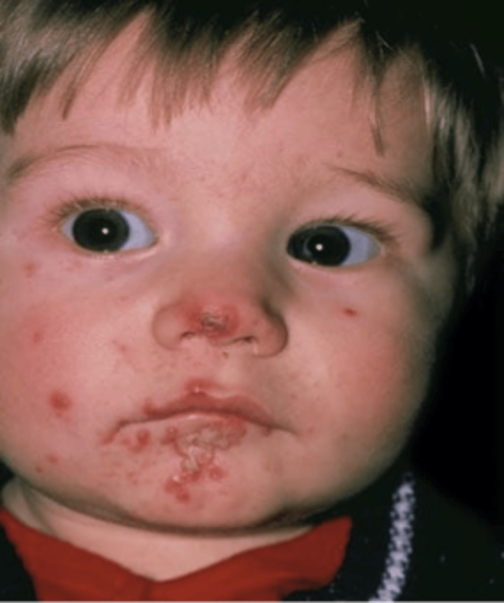 <p>Honey crusted lesions that are causes by streptococcus or staphylcoccus from nose picking or scratching</p>