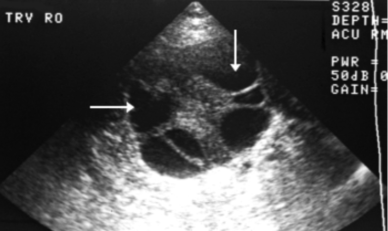 <ul><li><p>Bilateral</p></li><li><p>contain multiple cysts + septa</p></li><li><p><u>Largest</u> when <span style="color: rgb(255, 134, 0);"><strong>hCG</strong></span> <u>production at greatest</u></p><ul><li><p><span style="color: rgb(167, 0, 255);">12 - 24 weeks GA</span></p></li></ul></li><li><p>Have potential to <strong>twist</strong> and <strong>hemorrhage</strong>, causing <u>areas of solid echogenicity within cyst</u></p></li></ul><p></p>