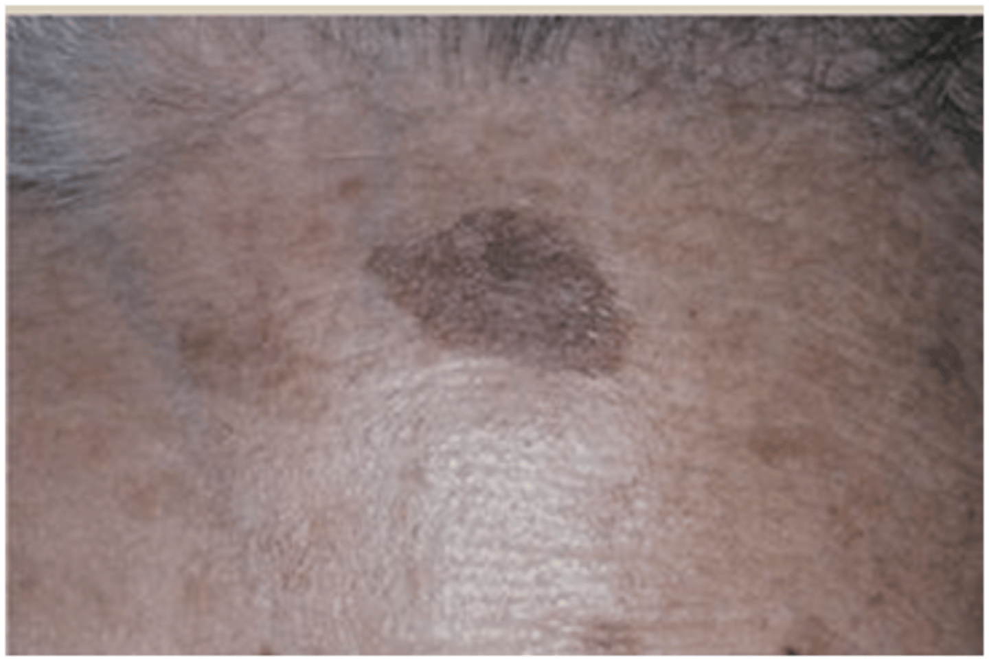 <p>treatment for which type of pigmented lesion:</p><p>• No treatment except for</p><p>cosmetic reasons</p><p>• Sunscreen = Prevention</p><p>• Does NOT undergo malignant</p><p>transformation</p><p>• Photo damaged skin indicates a</p><p>risk for developing other skin</p><p>cancers</p>