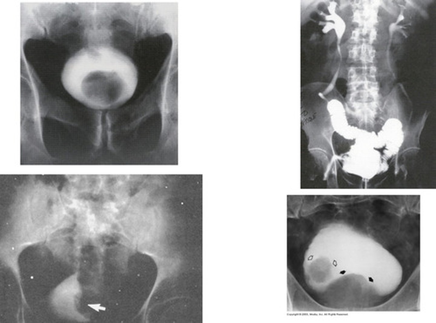 <p>- What type of cancer causes fingerlike projections into the bladder wall?</p><p>- What is this cancer associated with?</p><p>- What sex and age does this cancer affect?</p><p>- What is the best method of diagnosis?</p><p>- What imaging modalities determine the extent of this cancer?</p>