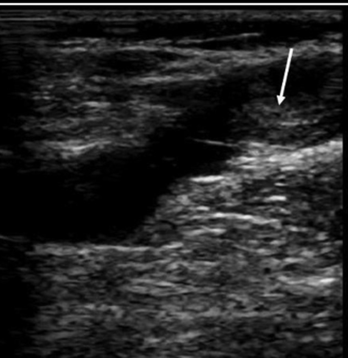 <p>May be remnants of previous clot</p>