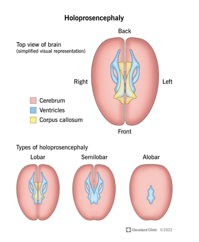<ul><li><p>A disorder caused by the failure of the prosencephalon (embronic forebrain) to sufficiently divide into double lobes of the cerebral hemisphere — leading to a single-lobed braine structure with severe skull &amp; facial defects</p></li><li><p>3 types —</p><ul><li><p>Alobar </p><ul><li><p>Where 2 hemispheres are completely fused</p></li></ul></li><li><p>Semilobar —</p><ul><li><p>Where there is frontal &amp; parietal fusion </p></li></ul></li><li><p>Lobal </p><ul><li><p>Where there is only frontal fusion </p></li></ul></li></ul></li></ul>