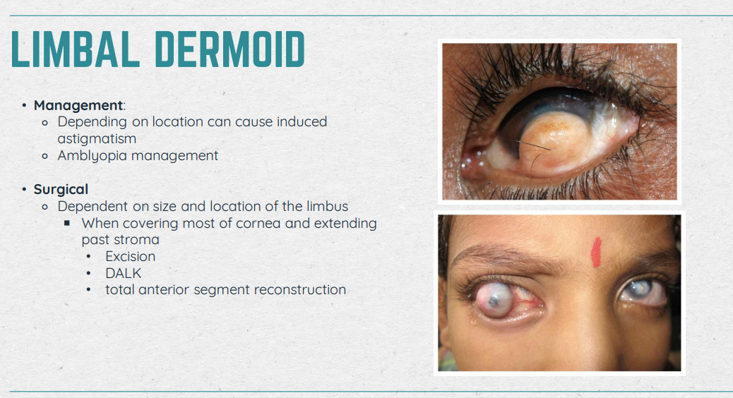 <ul><li><p>Congenital choristoma of limbus/cornea</p></li><li><p>Characteristic: White/yellowish solid lesions, opaque, marginally vascularized; Sporadic (hair sticking out of them)</p></li><li><p>Goldenhar Syndrome: jaw abnormalities + ear malformations + eye dermoids</p></li></ul><p></p>