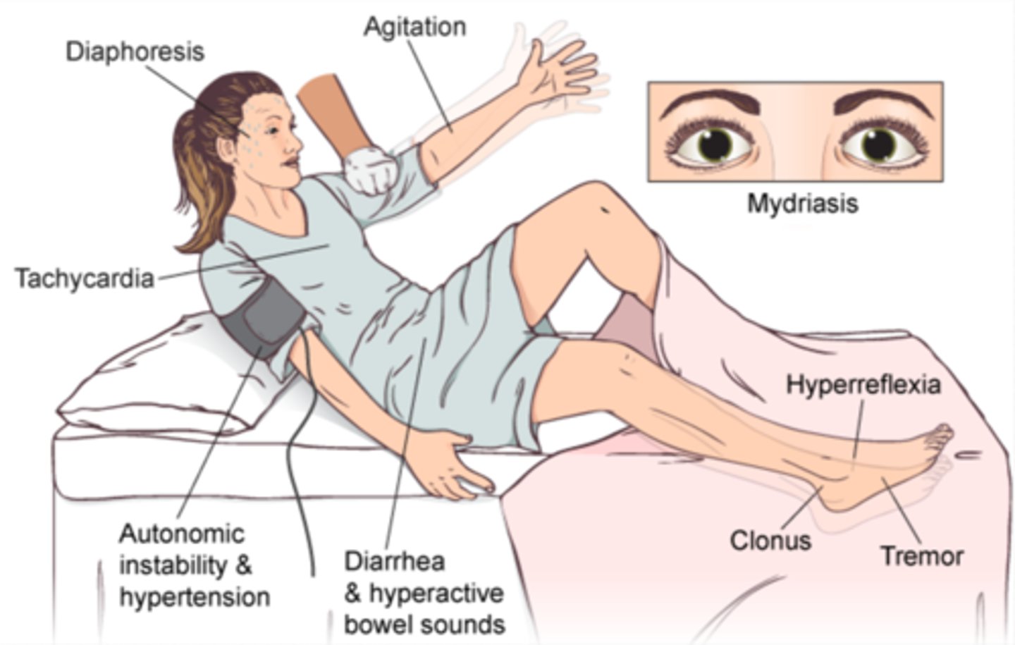<p>Autonomic: Tachycardia, HTN, hyperthermia, tachypnea, diaphrosis</p><p>Mental: Confusion, agitation, coma</p><p>Neuromuscular: HYPER-reflexia, tremors, clonus, clonus, rigidity</p>