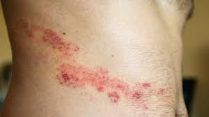 <p>What type of skin lesion is this? Give an example.</p>