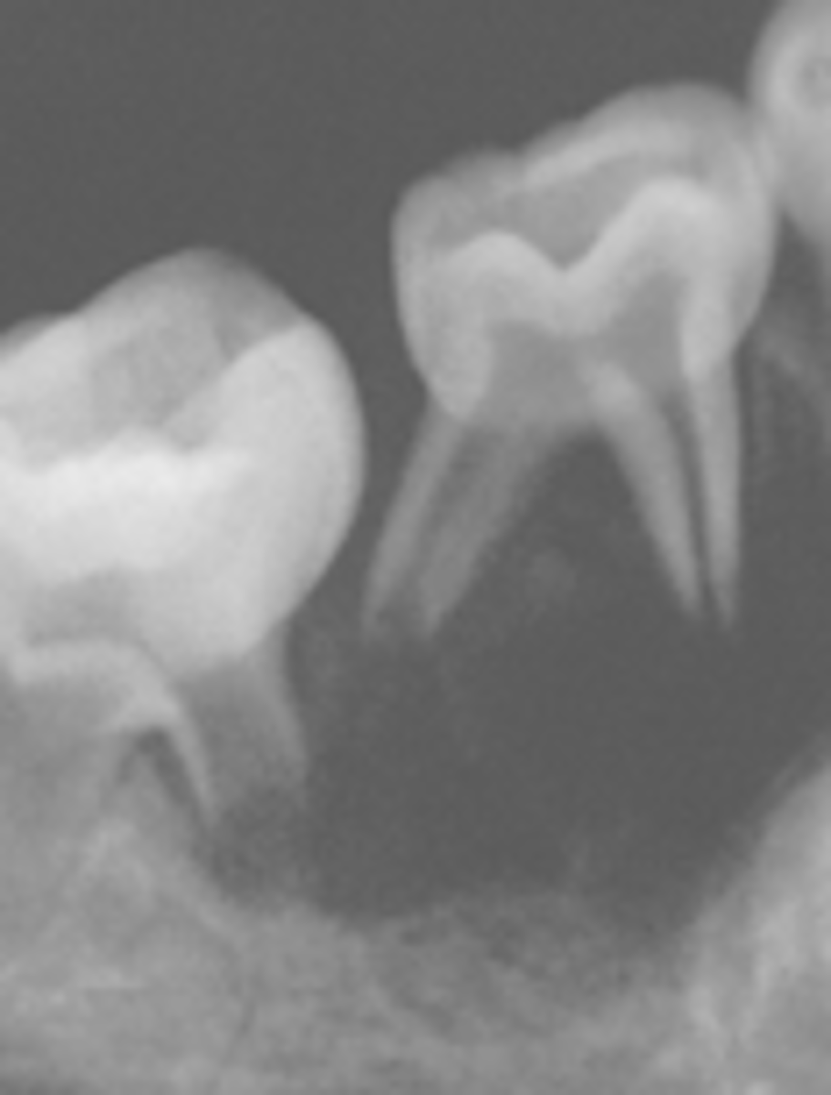 <p>-"teeth floating in air"</p><p>-aggressive, rapidly growing lesion</p>