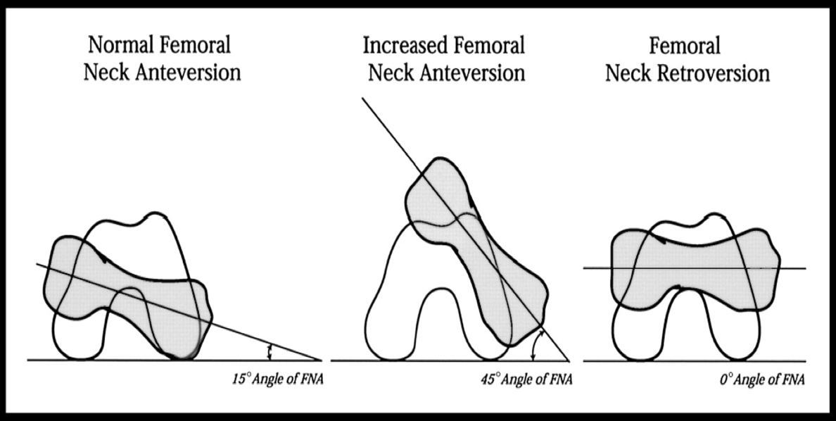 <p>what is the normal femoral neck anteversion </p><p>what is the increased femoral neck anteversion </p><p>what is the femoral neck retroversion</p>