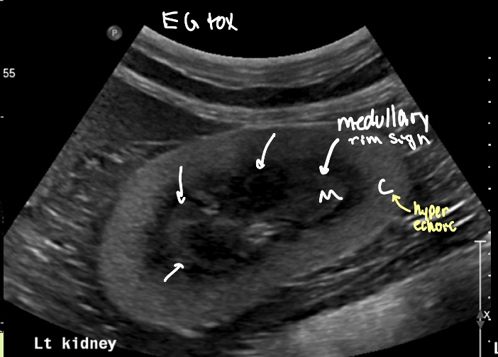 <p>is the medullary rim sign something to be worried about</p>