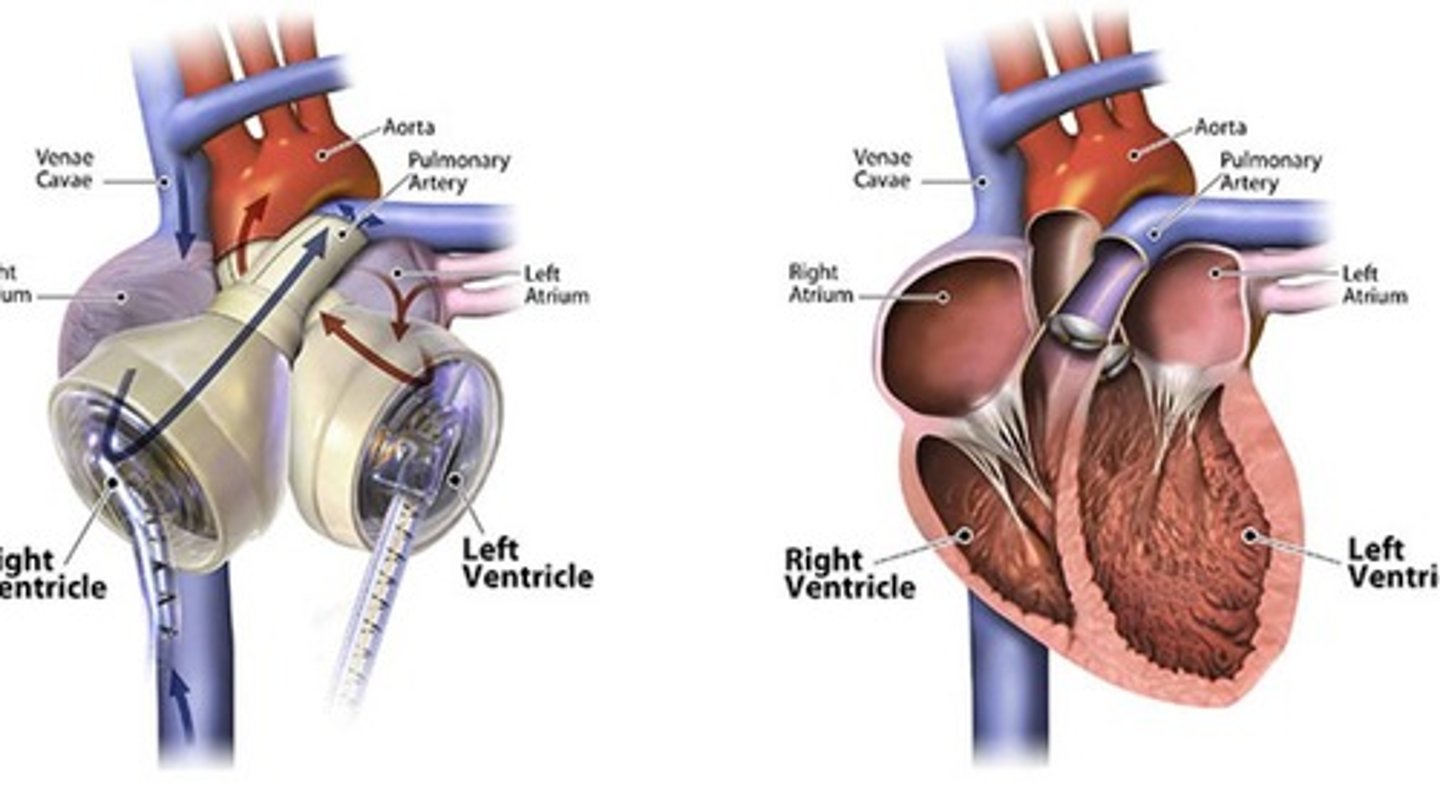 <p>Device monitoring heart rhythm, delivering shocks if needed.</p>