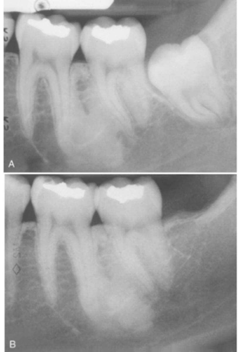 <p>Does Idiopathic Osteosclerosis cause bone expansion?</p>