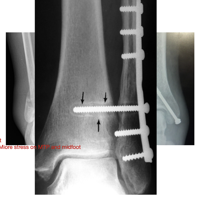<p>In this Ankle Malleolar Fx, what is surrounding the screw?</p><ul><li><p>Why occurring?</p></li></ul><p></p><p></p>