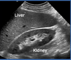 <p>Echogenicity of this </p>