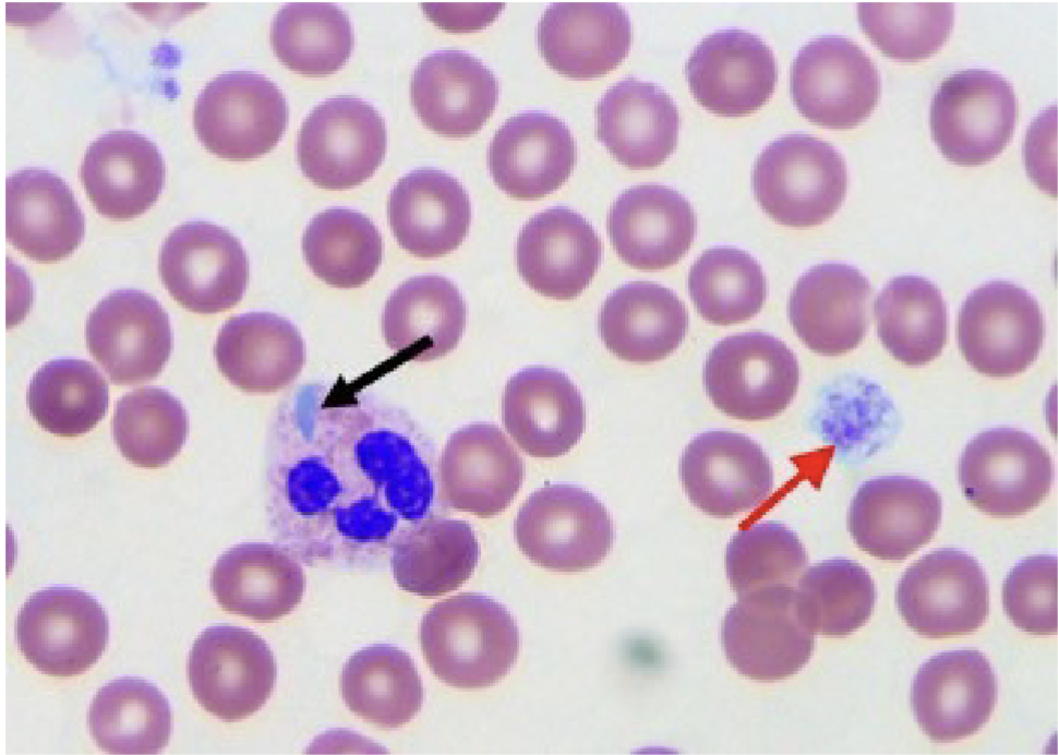 <ul><li><p>Red arrow points to giant platelet</p></li><li><p> Black arrow points to May-Hegglin body. Note</p><p>the neutrophil with the blue inclusion</p></li><li><p> If large quantity of giant platelets exist, the</p><p>automated platelet count might be falsely decreased</p></li><li><p> Size falls outside upper threshold of automated analyzers</p></li></ul><p></p>