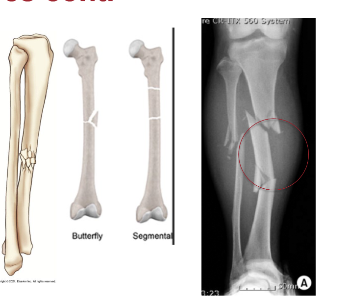 <p>Bone is splintered or crushed at site of impact resulting in two or more fragments</p><ol><li><p>Segmental</p></li><li><p>Butterfly</p></li><li><p>Splintered</p></li></ol><p></p>