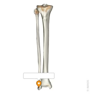 <p>Distalmost point of the Fibula that forms one of the bumps of the ankle </p>