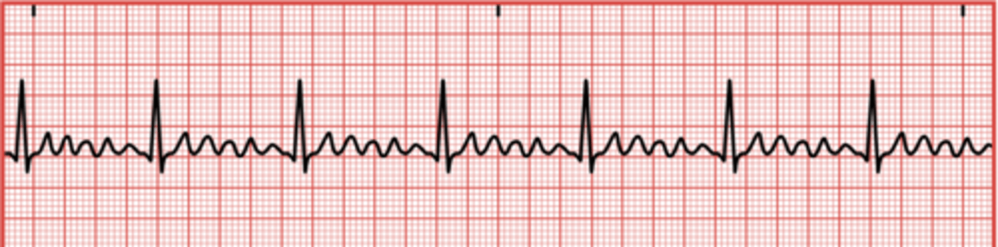 <p>A condition where the atria beat at an extremely rapid rate, up to 300 beats per minute.</p>