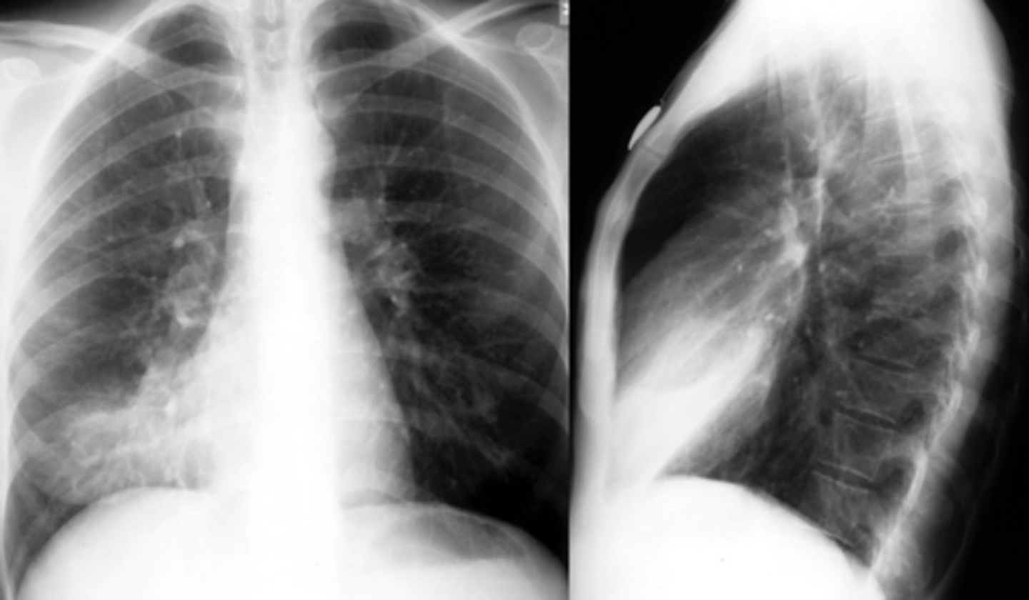 <p>note the classic silhouette sign here</p><p>- what should be a sharp, well defined R heart border is "lost" due to superimposition of the infiltrate</p>
