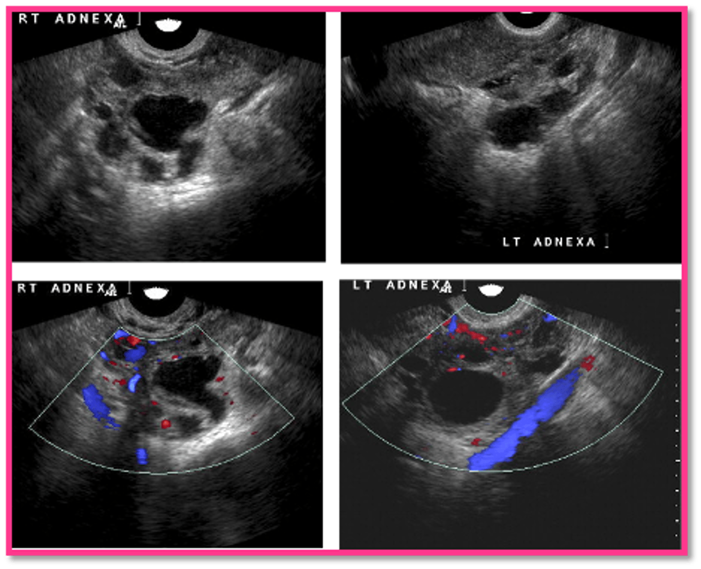 <p>ovarian remnant syndrome</p>