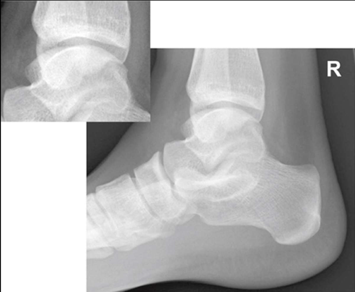 <p>is this lateral ankle over or under rotated</p>
