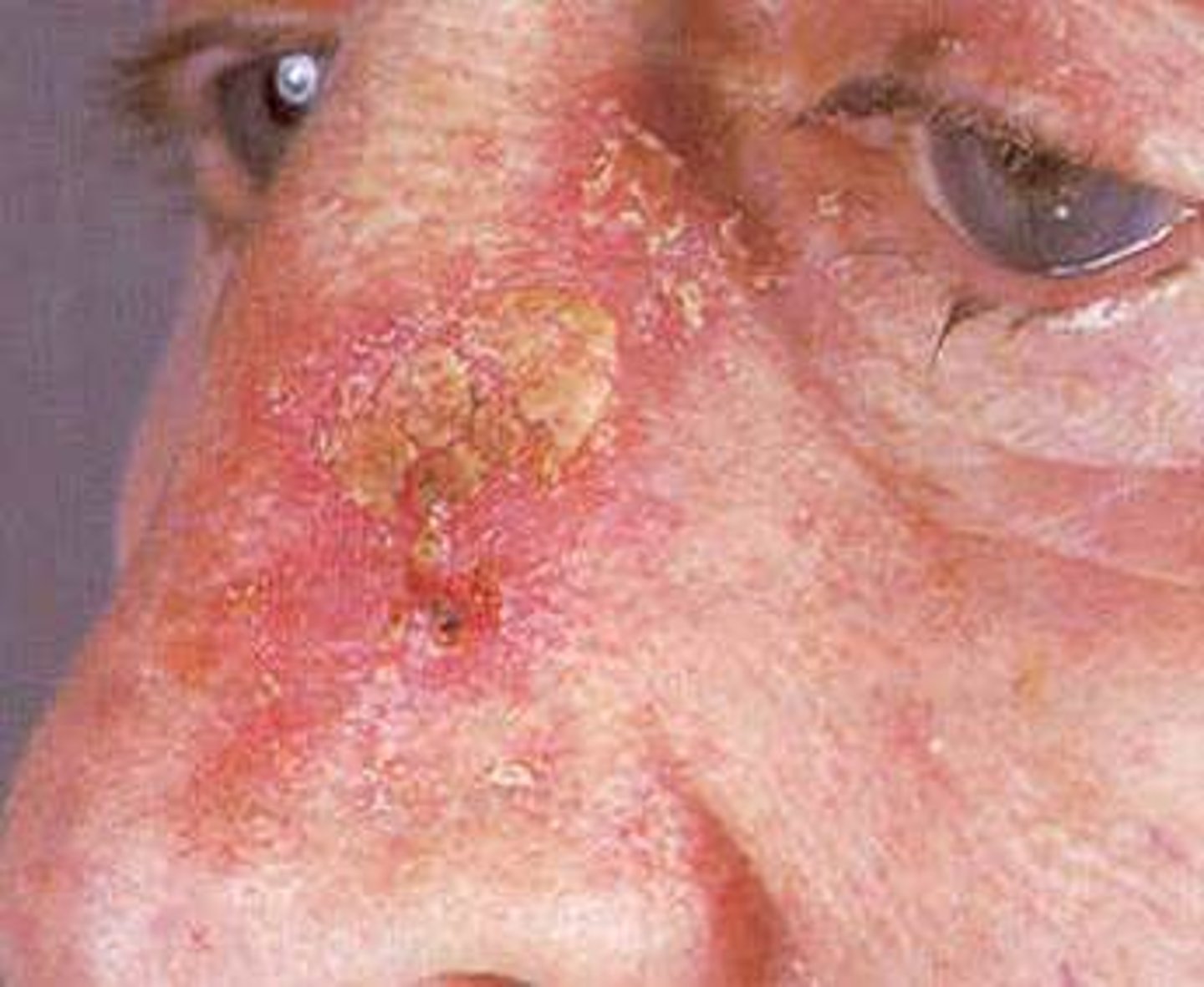 <p>Actinic Keratosis</p>