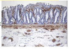 <p><span><strong>A 3 month old boy is brought to the ER with a 3-day history of fever, explosive diarrhea, a soft abdomen, vomiting, and lethargy. Anorectal manometry is abnormal. Biopsy of the rectal tissue is stained for acetylcholinesterase. A sample of the biopsy is negative for calretinin and positive for silver impregnation. The most likely cause of the patient's symptoms are?&nbsp;</strong></span></p><ul><li><p><span>The absence of ganglion cells at the submucosal and myenteric plexuses&nbsp;</span></p></li><li><p><span>Deficiency of the argyrophil plexus&nbsp;</span></p></li><li><p><span>Lack of AChE activity in the mucosa&nbsp;</span></p></li><li><p><span>Small immature ganglion cells in the submucosal plexus&nbsp;</span></p></li><li><p><span>Thick nerve trunks accompanied by the giant ganglia&nbsp;</span></p></li></ul><p></p>